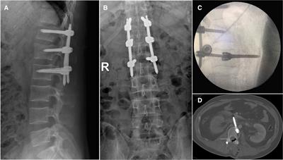 Severe major vessel injury during peadicle screw removal: a case report